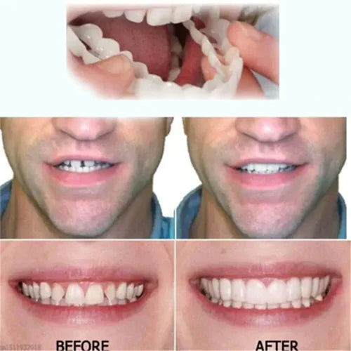 Oralux Snap On Dentures